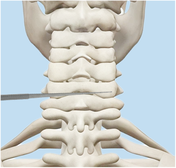Lower cervical probing illustration