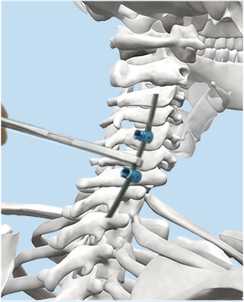 Rod implanting illustration