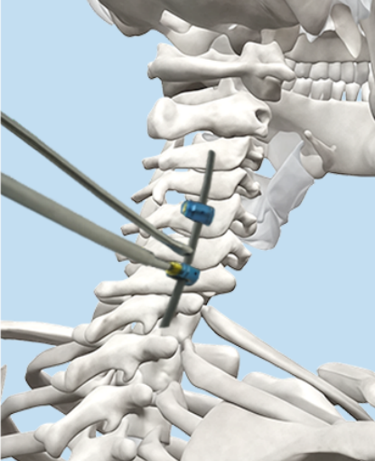 Preload wrench and screw plug illustration