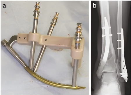 Intraoperative fluoroscopic confirmation of retrograde intramedullary nail position and nail trajectory across fracture site