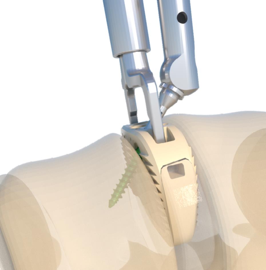 Pre-loading the ALIF locking screw