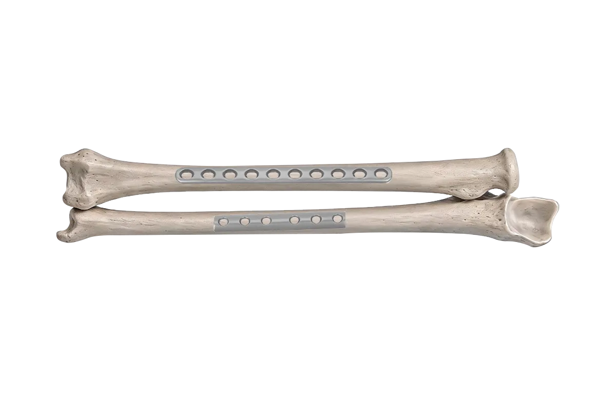 LC-DCP Ulna and Radius Plate and One-third Tubular Plate systems