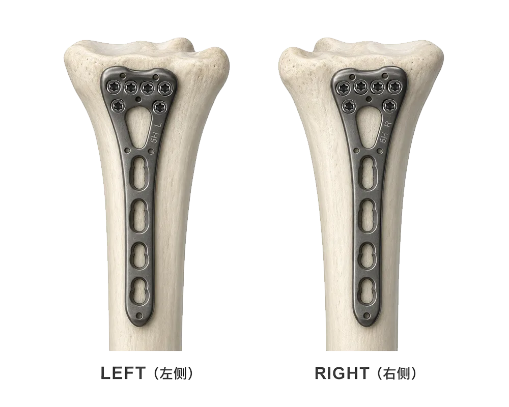 Left and right radial head plate configurations