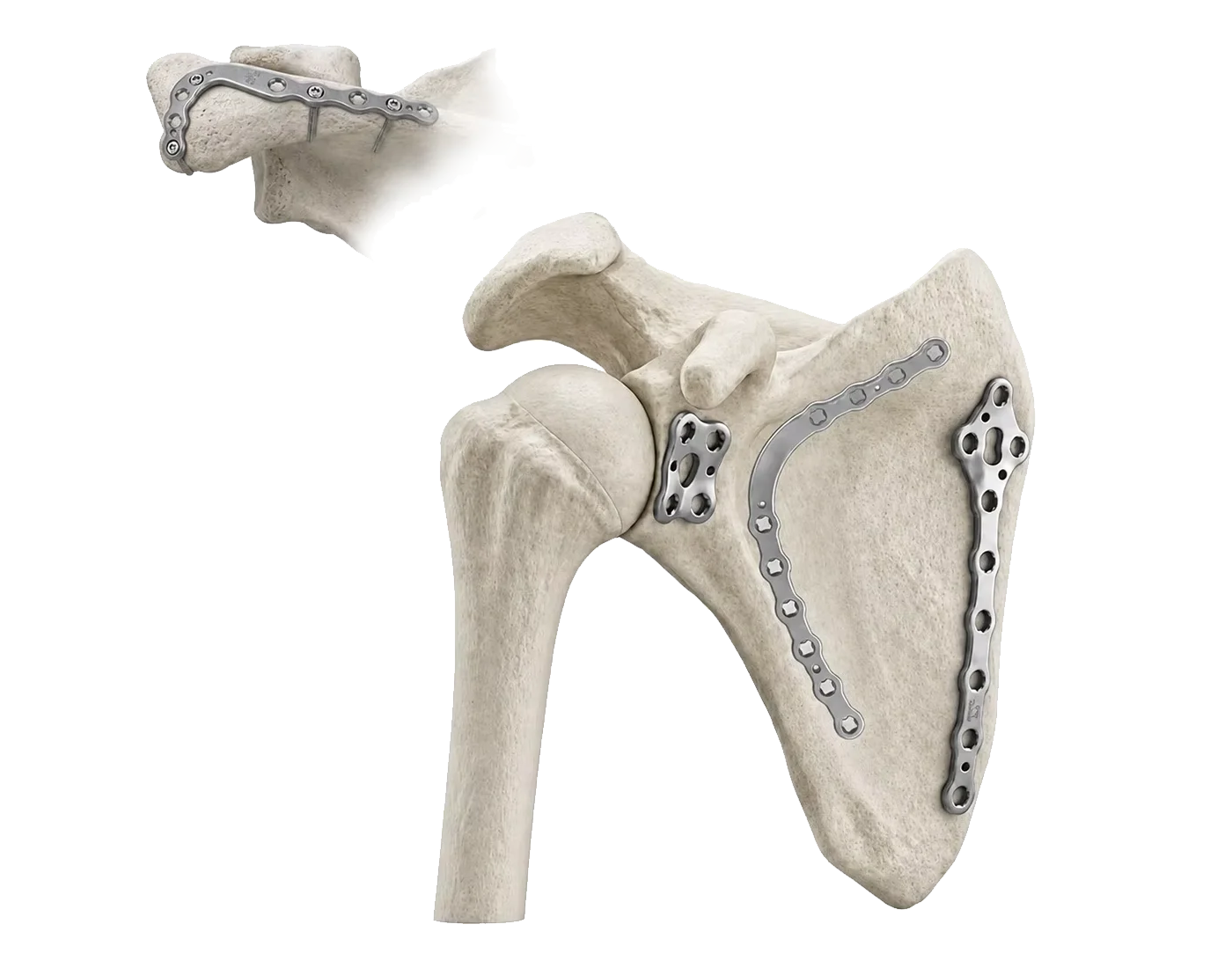 Scapula and glenoid fracture fixation system
