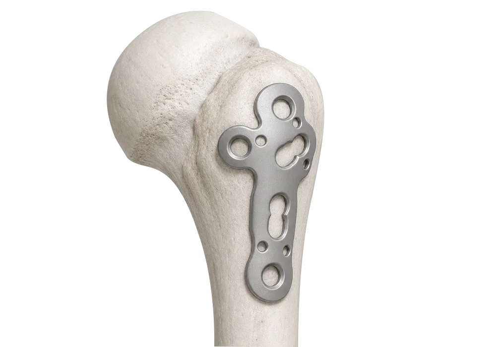 Proximal humerus locking plate fixation route