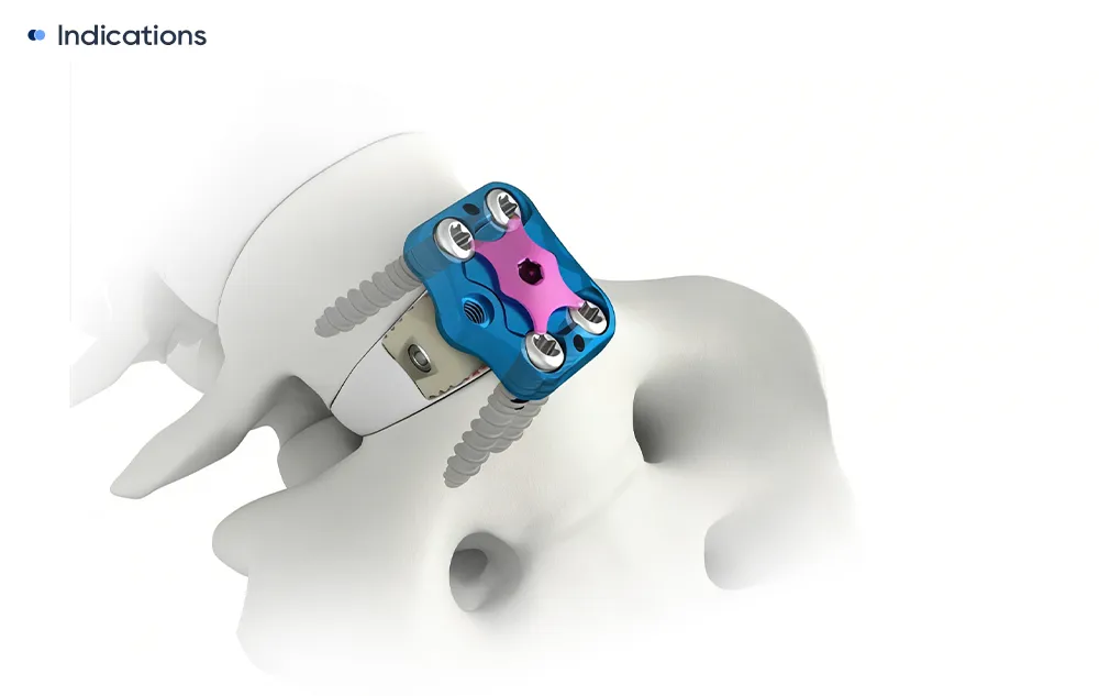 Anterior lumbar interbody fusion plate with Φ5.5 locking screws implanted on a lumbar vertebral body