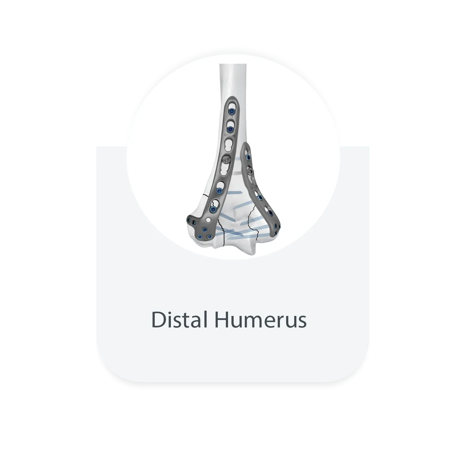 Distal humerus locking plate