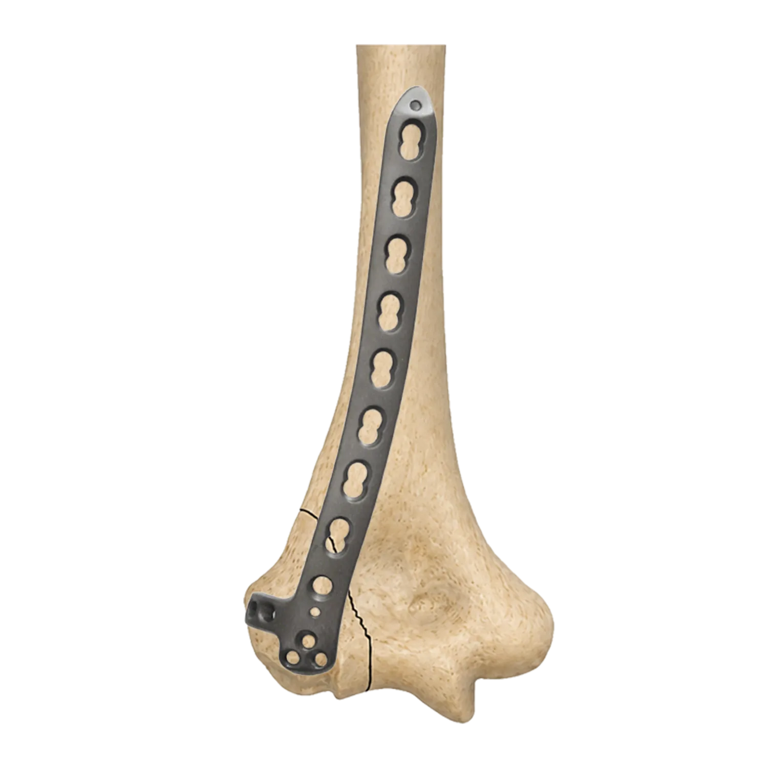 Distal humerus lateral locking plate fixed on humerus bone model across a lateral column fracture