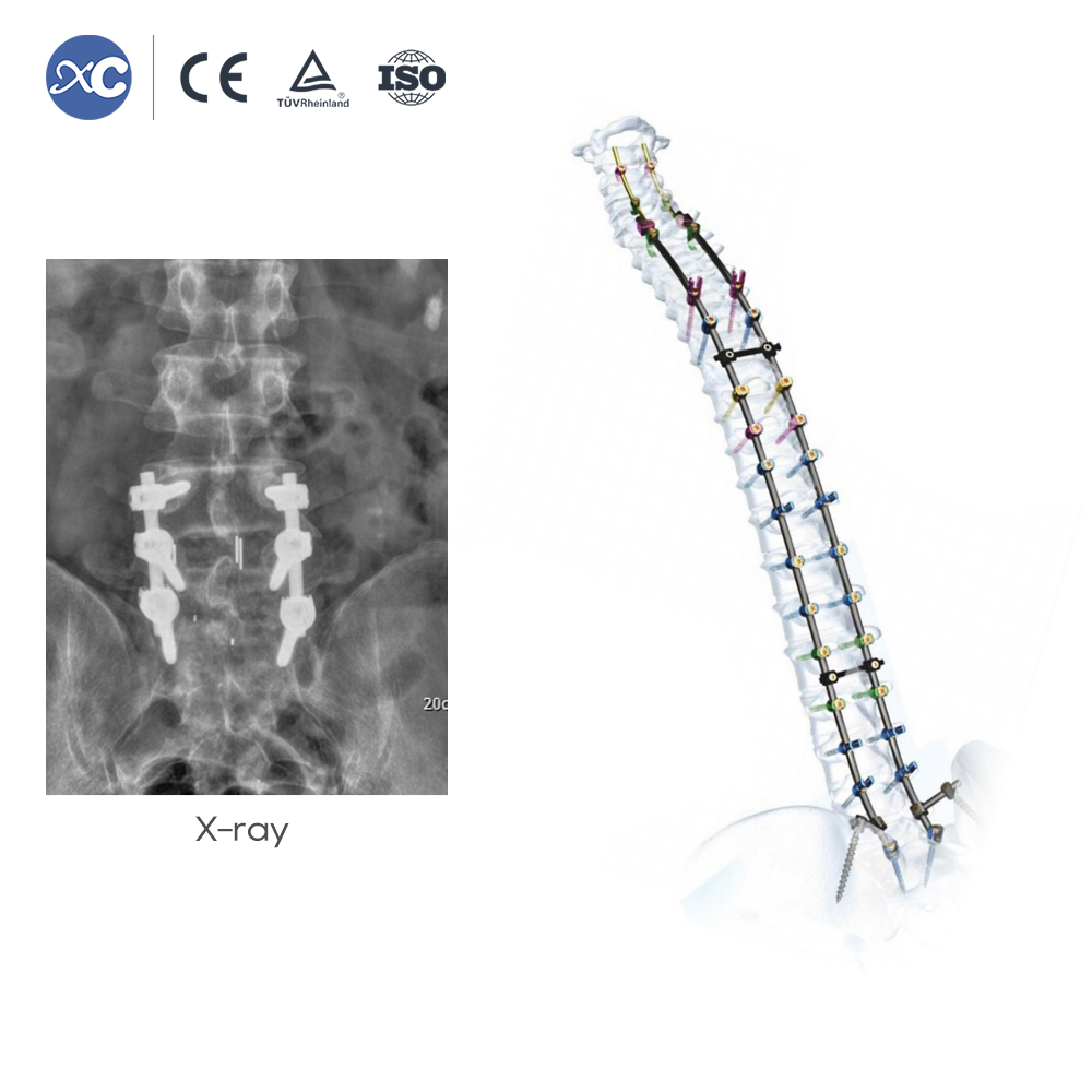 MLD Articulating Retractor Set Ensengeka y'ebintu | Ebikozesebwa mu kusala ebitundu by’omubiri ebiyitibwa Micro Lumbar Discectomy