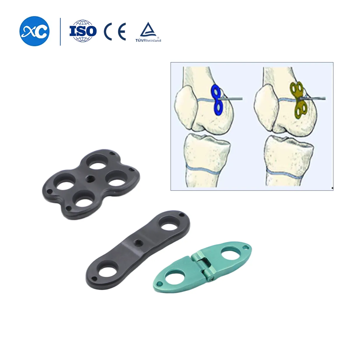 Pediatric Valgus Varus Orthopedic System | Limb Deformity Correction Implant- 2