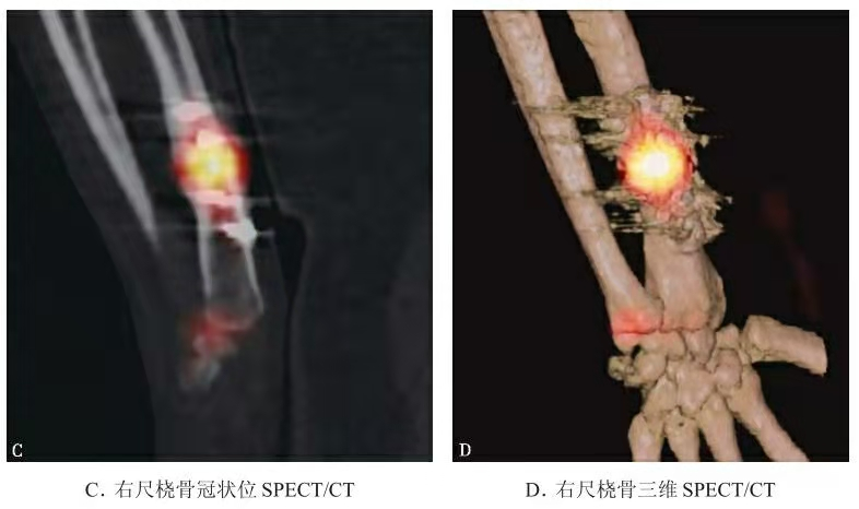 Representative SPECT/CT showing tracer activity near distal radius fracture