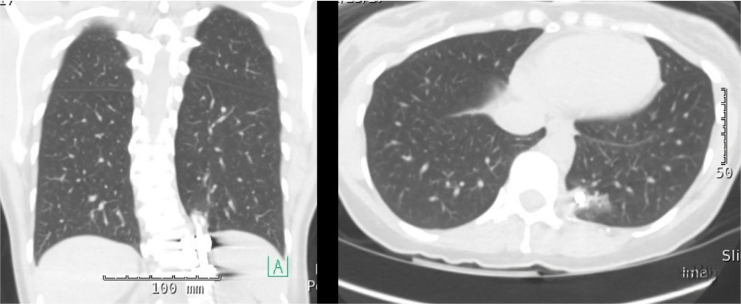 Axial and coronal CT scans demonstrating the exact position of the migrated rod in the lung field
