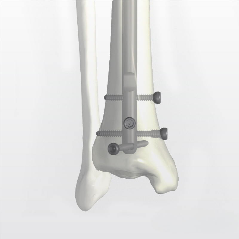 Tshiab Tibia Intramedullary Nail | Orthopedic Fixation | XC Medico
