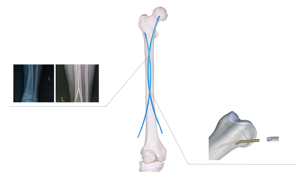 Dual nail stability and minimally invasive pediatric elastic nail fixation design
