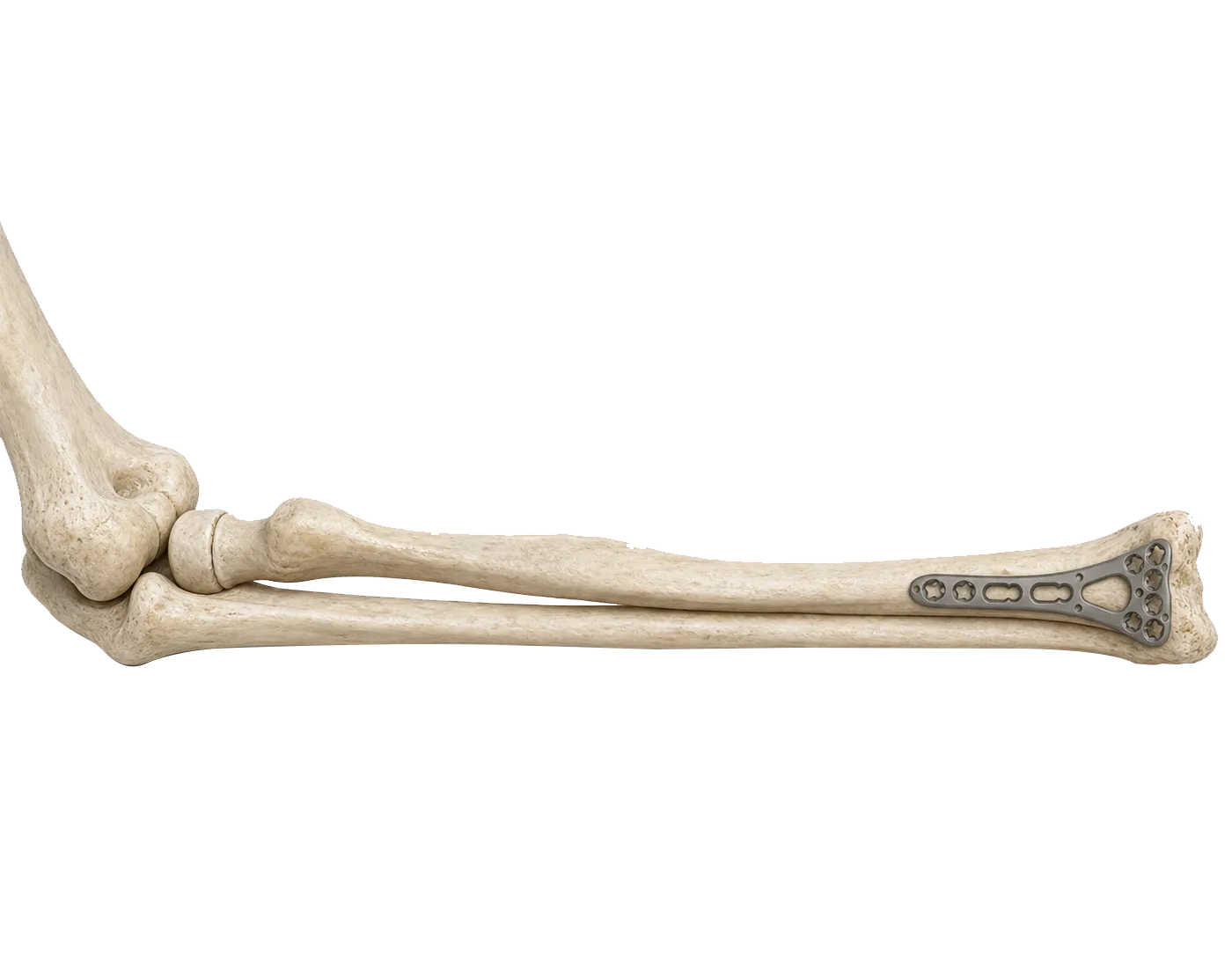 Radial head fracture fixation with a Capitulum Radialis Locking Plate