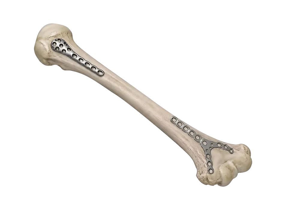 Proximal humerus non-locking plate fixation route