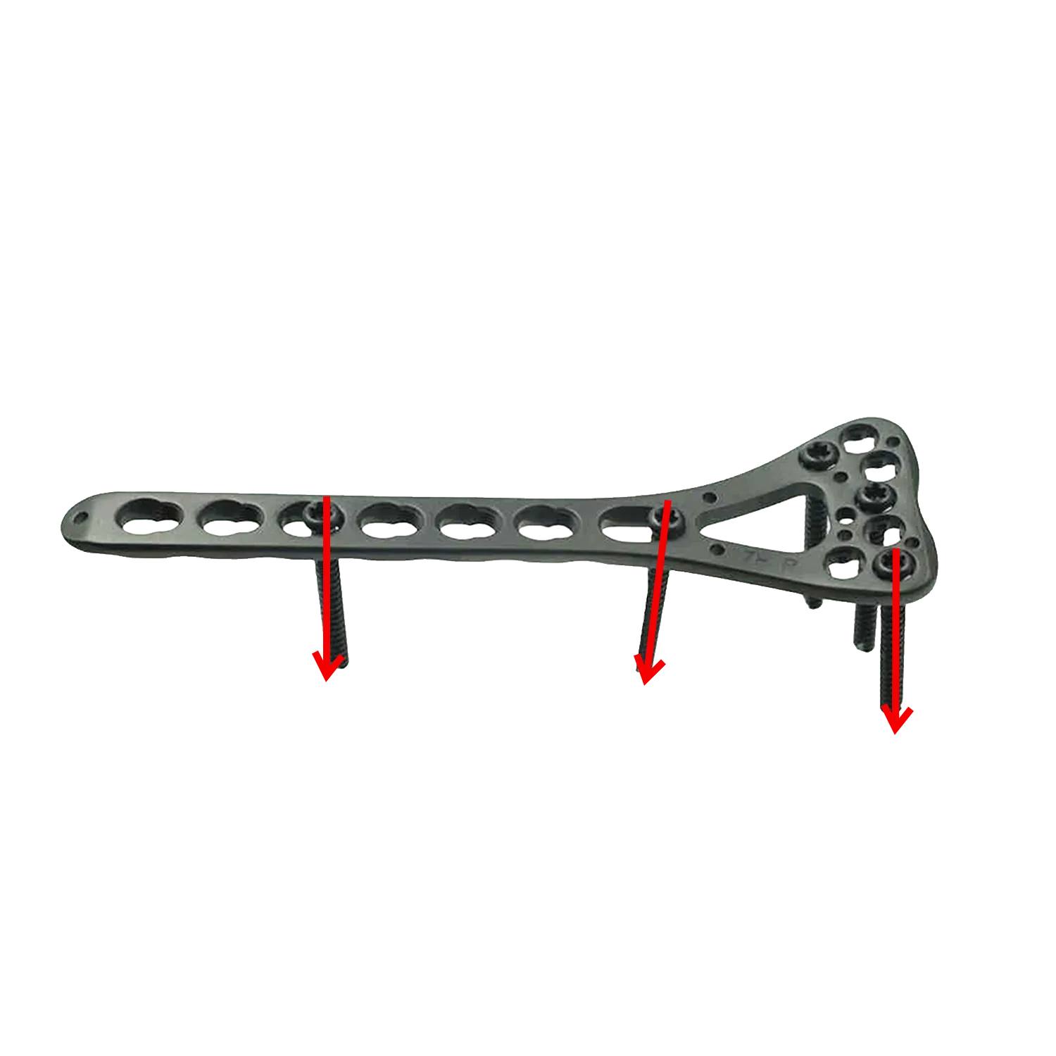 Multi-angle locking screw trajectories of the distal radius locking plate