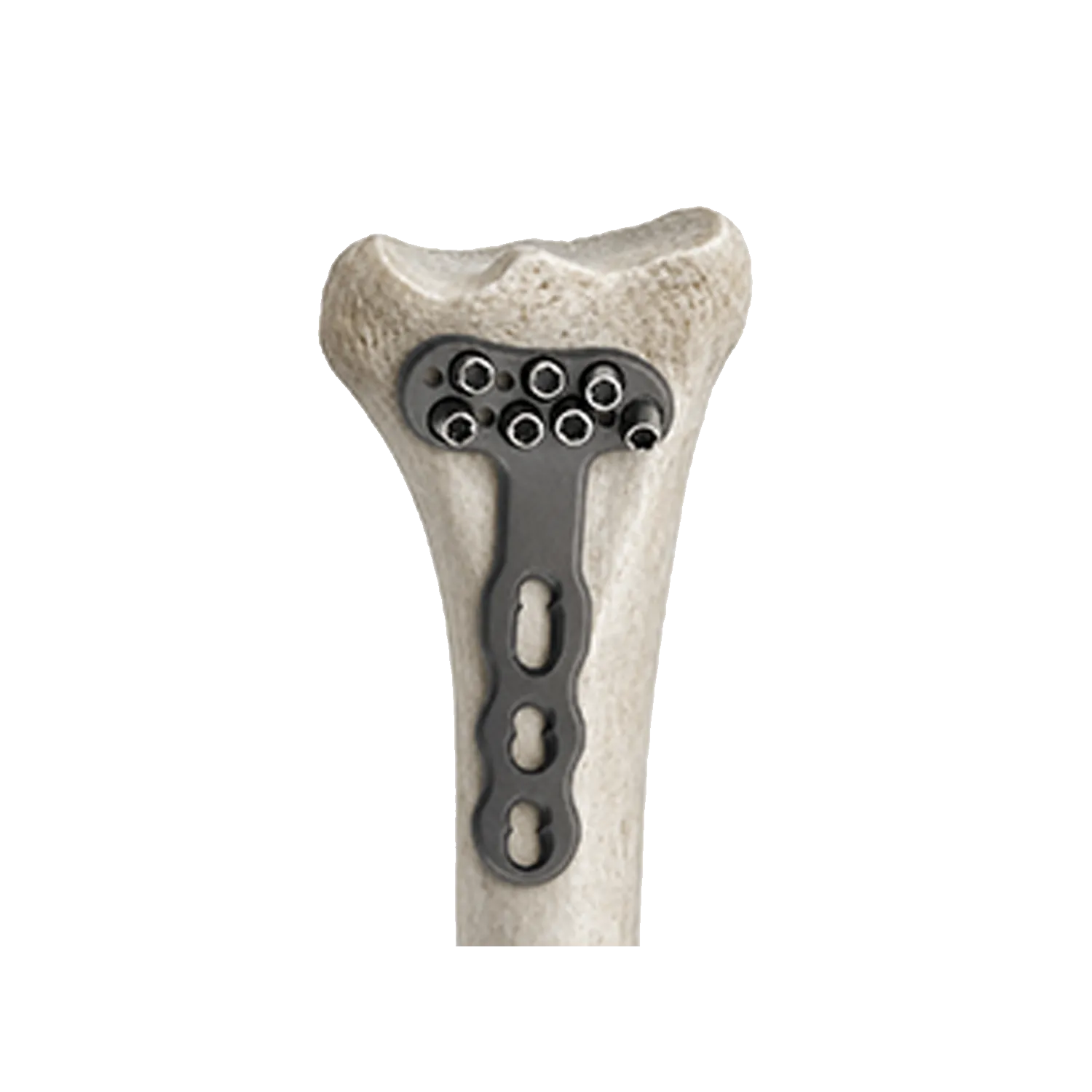 Distal radius locking plate DVR fixed on a radius bone model