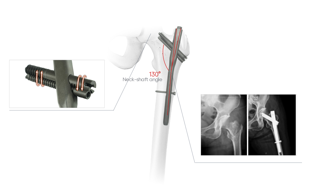 Compression Interlocking Nail, 6&deg; Lateral Angle Design, Distal Fluted Design
