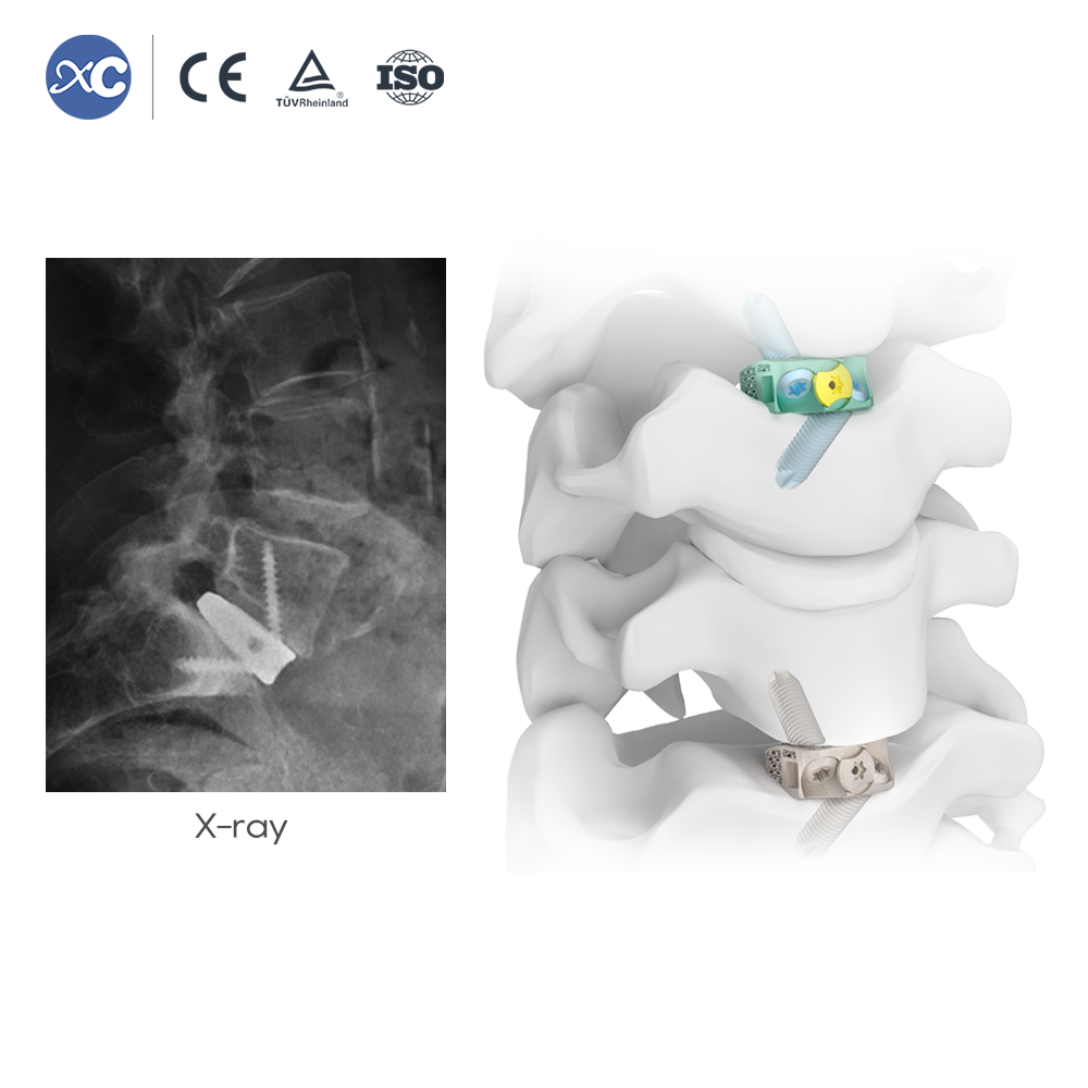 UBE Laminectomy Forceps uye Pituitary Forceps Instrument Set - Tenga Chigadzirwa paXC Medico