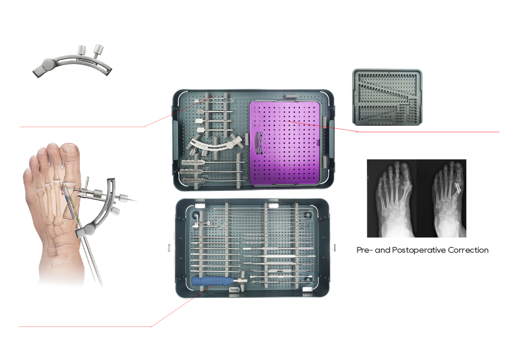 Trajectory Guide Assembly and Pre- Postoperative Correction X-Rays
