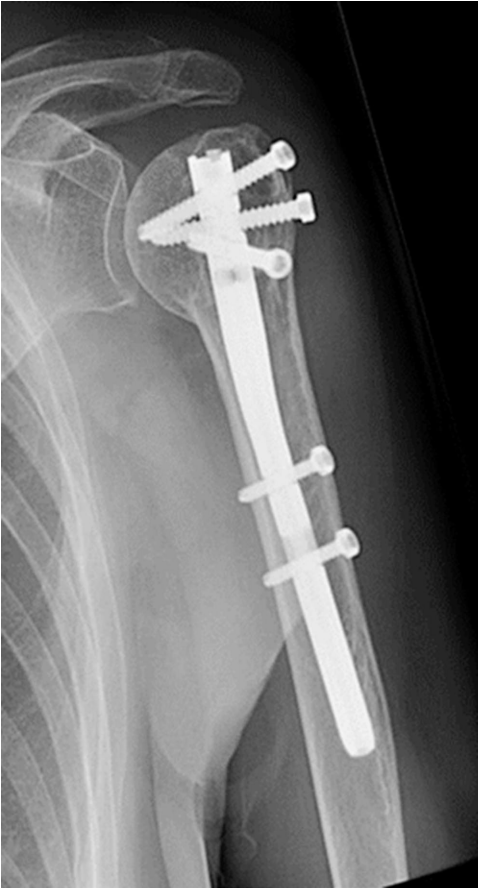 Anteroposterior radiograph at one year showing complete bony union with mature callus