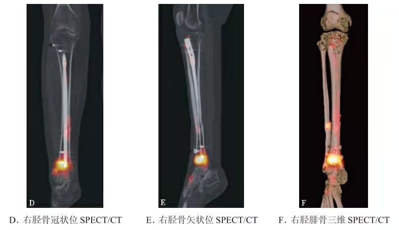 Representative SPECT/CT showing tibia/fibula fracture activity and implant-interface findings