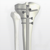 Tshiab Tibia Intramedullary Nail | Orthopedic Fixation | XC Medico