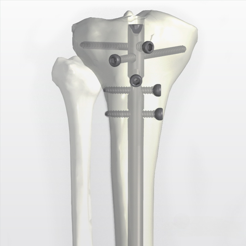Tshiab Tibia Intramedullary Nail | Orthopedic Fixation | XC Medico