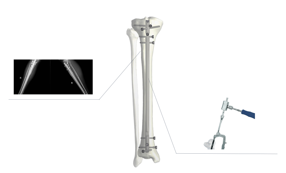 Biomechanics ntawm New Tibia Intramedullary Nail
