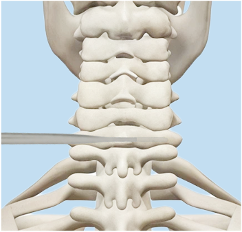Lower cervical screw entry illustration