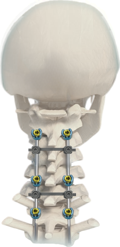Occipitocervical thoracic posterior spinal screw-rod system illustration