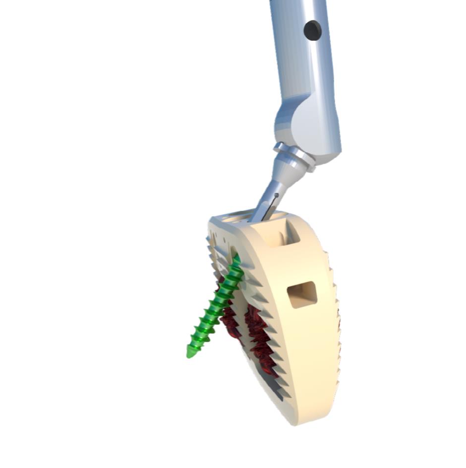 Close view of locking screw implantation