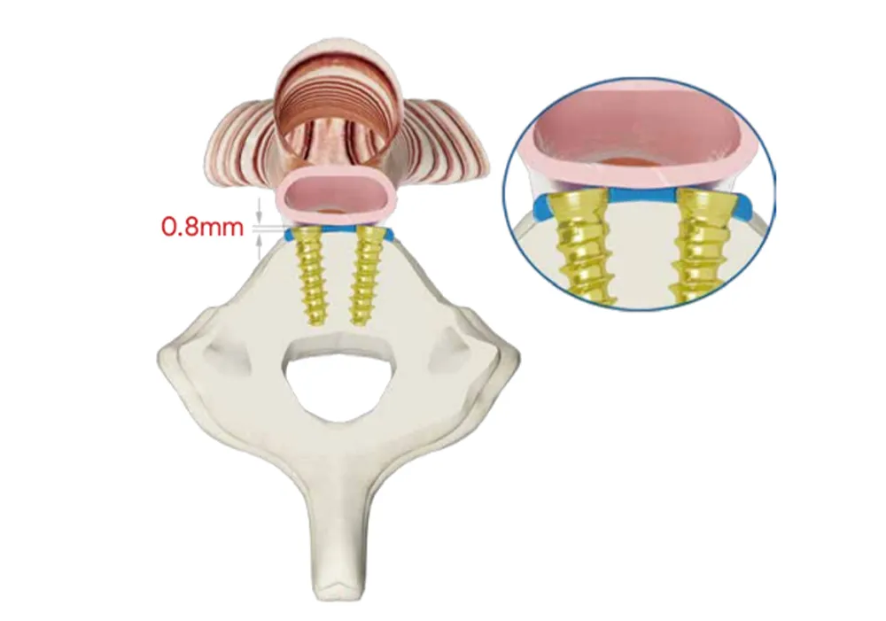 0.8mm ultra-thin antεriכr sεvikal plet profayl pan sεvikal vεrbra wit dual-thread skru dεm
