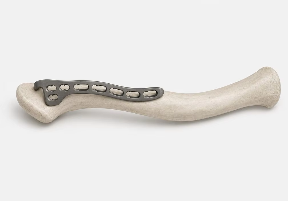 Claw style distal clavicle fixation