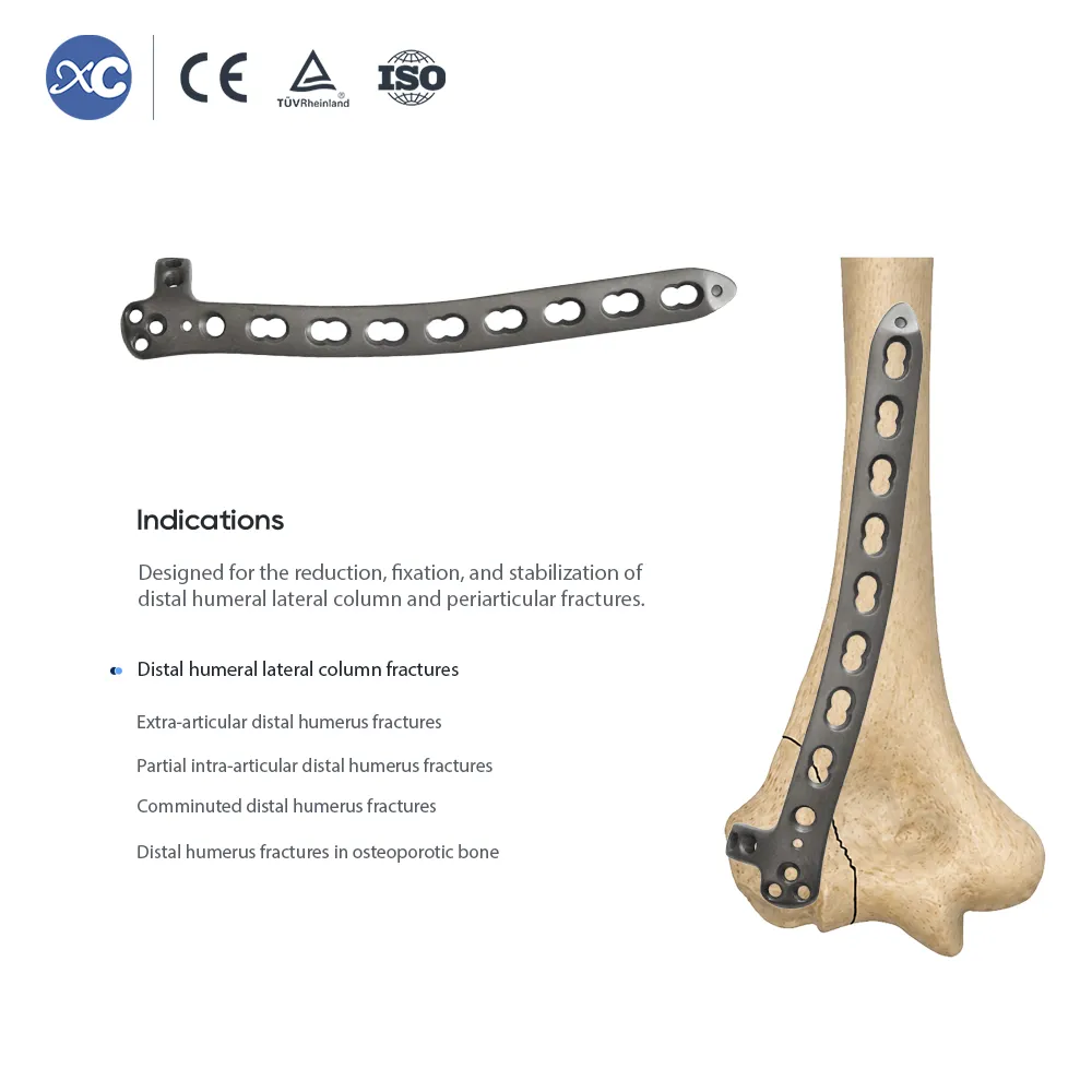 Distal humerus lateral locking plate fixed on humerus bone model