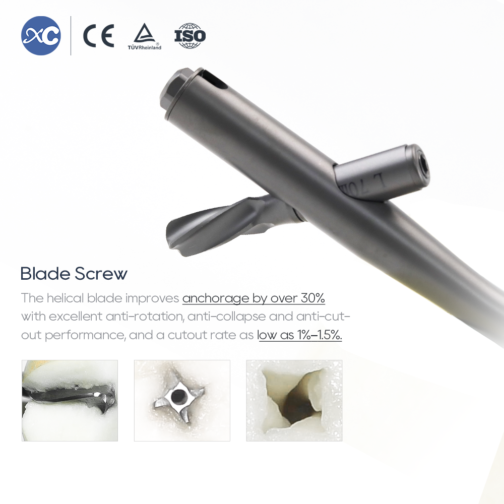 PFNA интрамедуларен пирон | Фиксиране на фрактура на проксимална бедрена кост