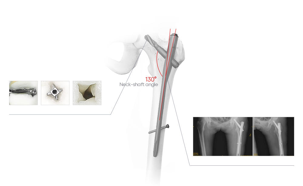 Biomechanics of PFN: 130 Degree Neck-Shaft Angle, 6 Degree Lateral Angle, and Helical Blade