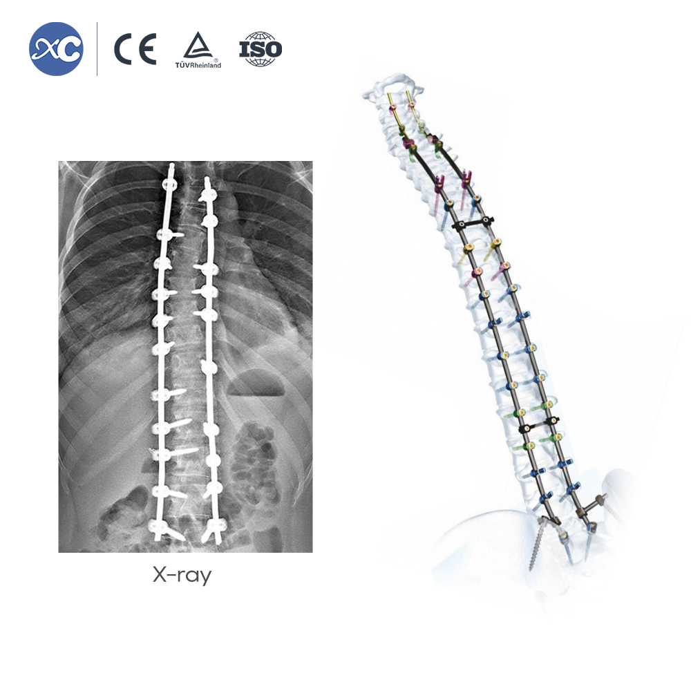 Маҷмӯи асбобҳои портали MIS Spinal - Маҳсулотро дар XC Medico харед