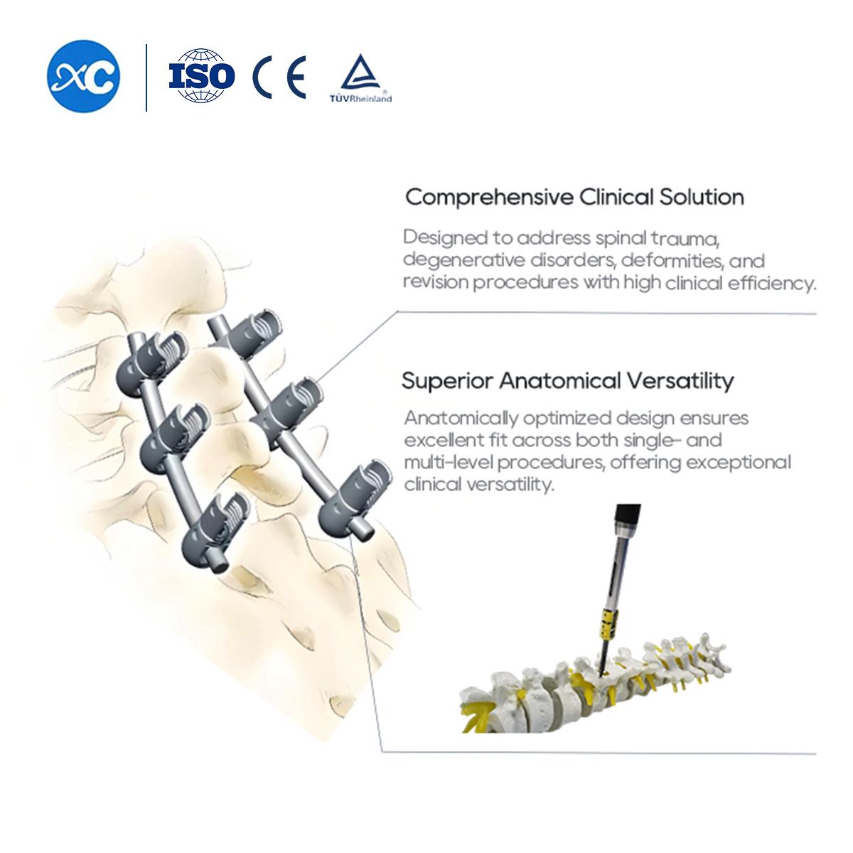 6.0mm Spinal Pedicle Screw System | Thoracolumbar Fusion | XC Medico