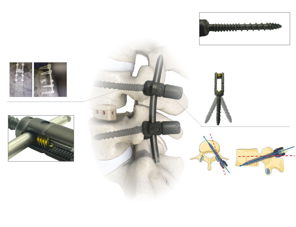 Stable Lumbar Fixation, Dual-Pitch Pedicle Screw, CBT vs Traditional Pedicle Screws
