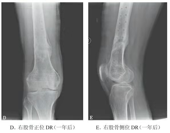Representative follow-up X-ray showing bridging callus progression