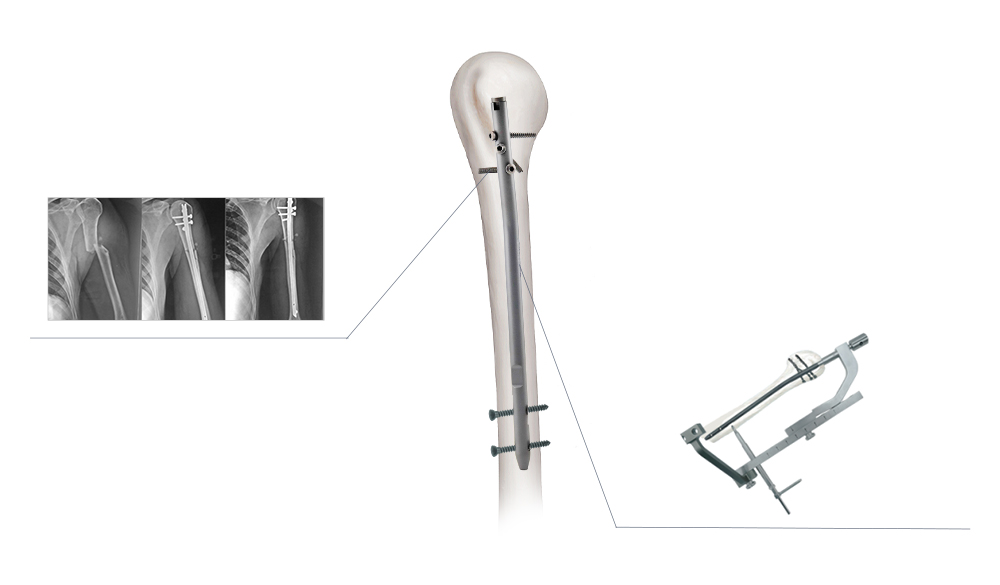 Axial Stability and Anatomical Multi-Angular Locking System for Humeral Fixation