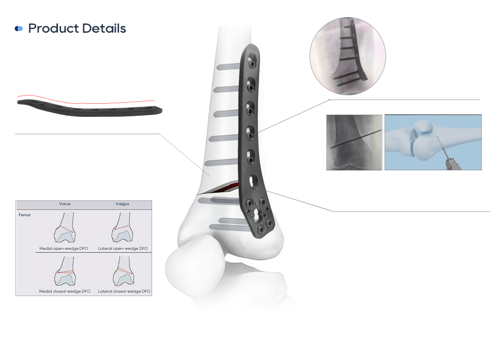 Biomechanics of the Lateral Distal Femoral Wedge Osteotomy Plate