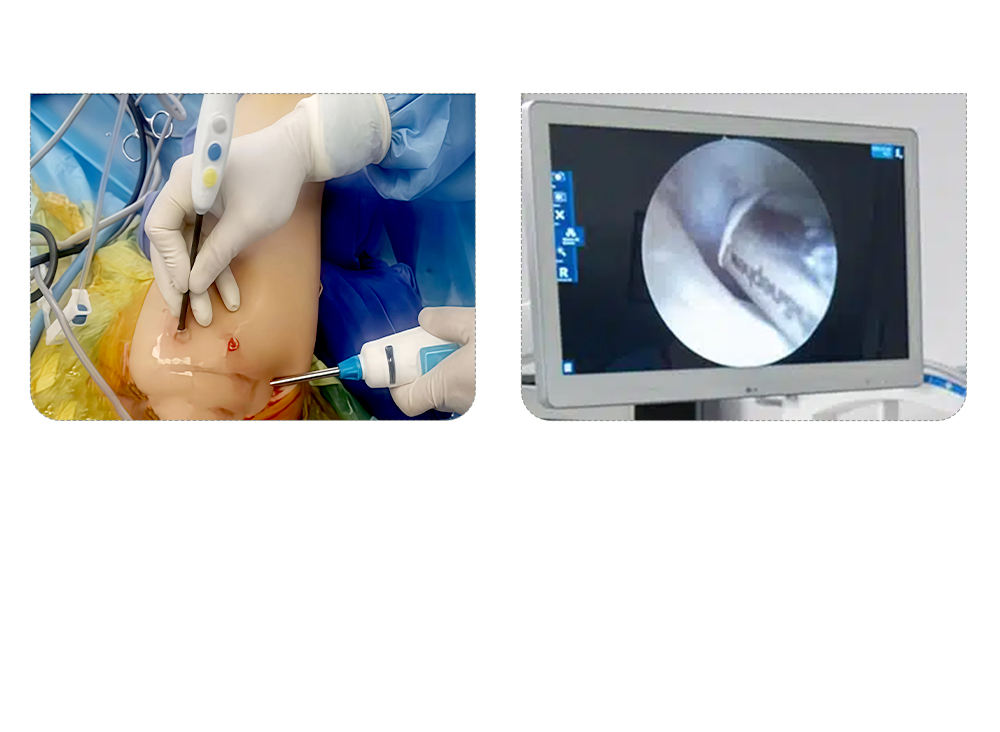 Disposable Sterile Arthroscope with High-Definition 4K Visualization