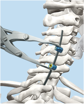 Compression method illustration