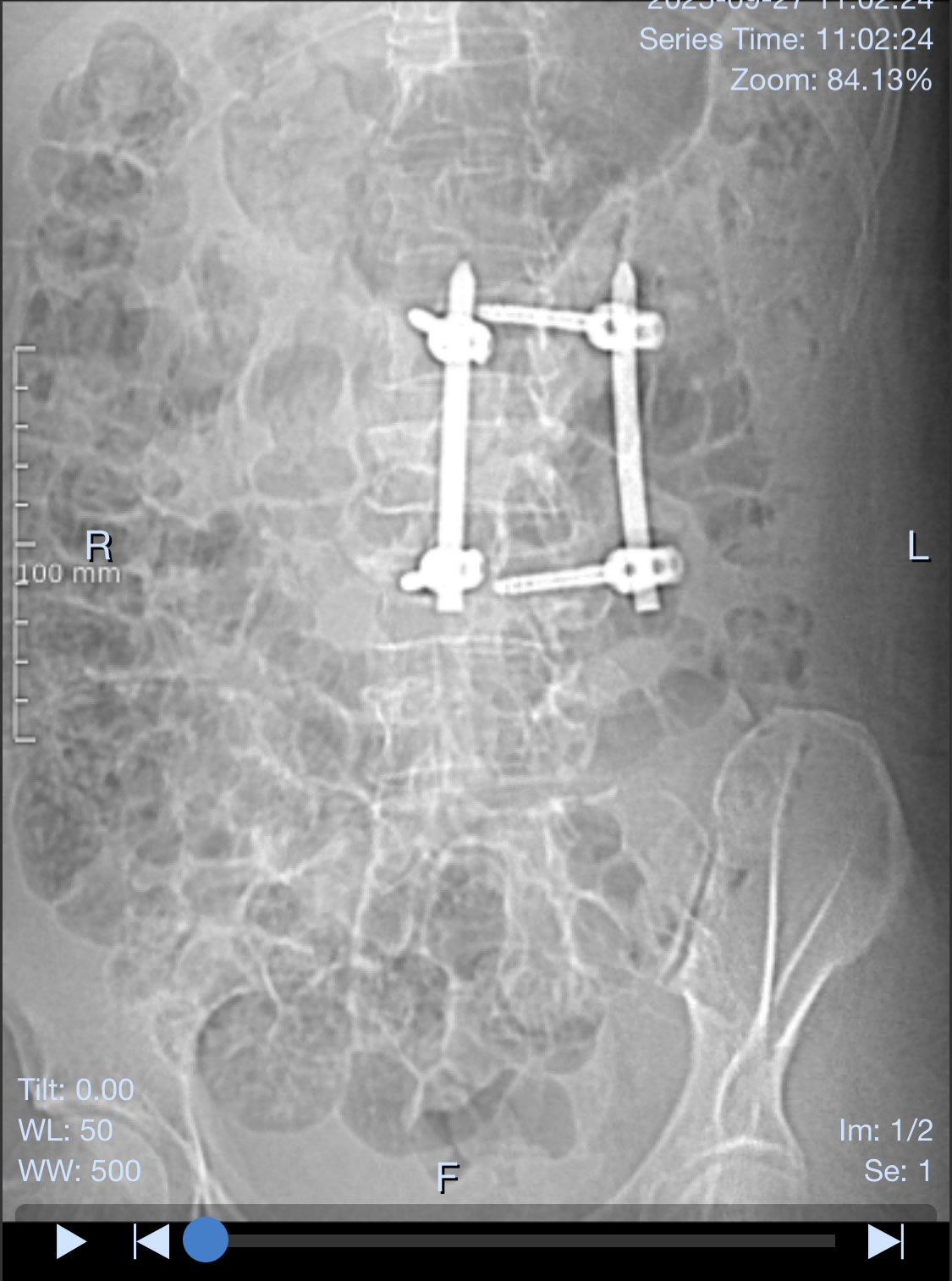 Post-operative CT of MIS Cement Augmented Fenestrated Screw in Spine