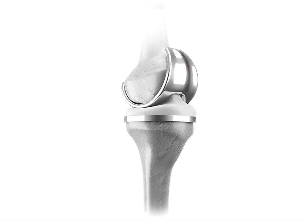 Total knee replacement prosthesis model with femoral component, insert and tibial tray